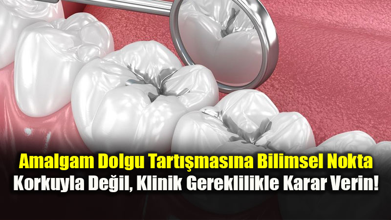 Amalgam Dolgular De�i�tirilmeli mi? 