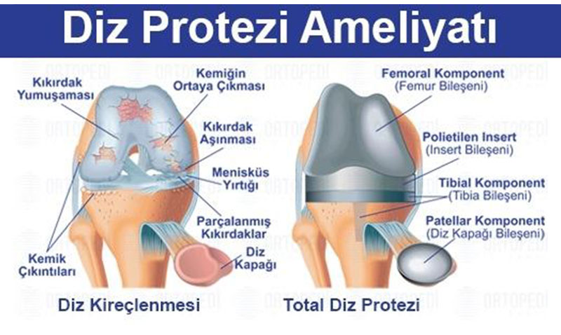 Diz Protezi Ameliyat� ve �yile�me S�reci: Akl�n�za Tak�lan Her �ey